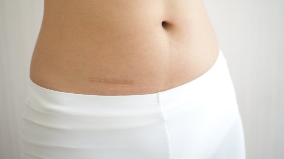 Аппендицит у взрослых