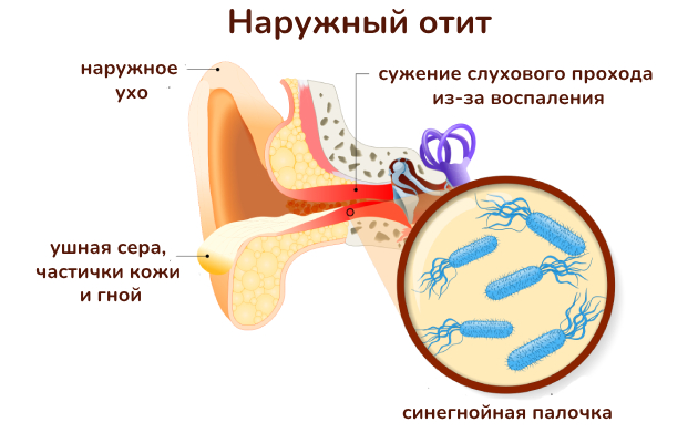Синегнойная палочка